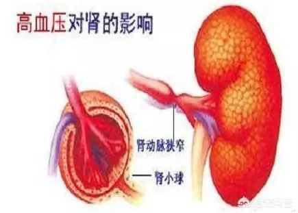 高血壓常與腎病「狼狽為奸」,怎樣預防高血壓腎病最高效?