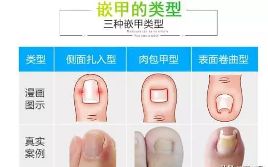 腳趾甲長進肉裡?1個土方法教你告別甲溝炎