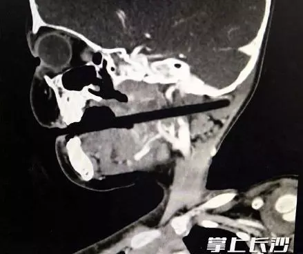 邊吃邊玩 結果跌倒 筷子插進頭顱 10公分
