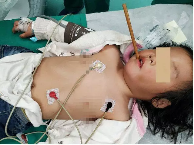 邊吃飯邊玩耍 3歲女童跌倒筷子插顱10公分
