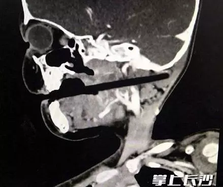 邊吃飯邊玩耍 3歲女童跌倒筷子插顱10公分
