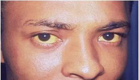 懷疑肝不好?對照這九條,超過三個趕緊就醫