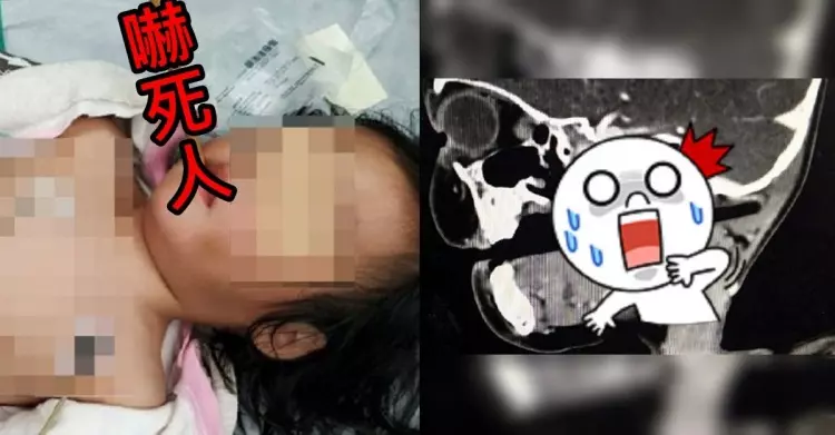 媽媽講的話真的要聽!女童吃飯玩耍「筷子入腦深插10cm」...超驚悚照片曝光:怕爆