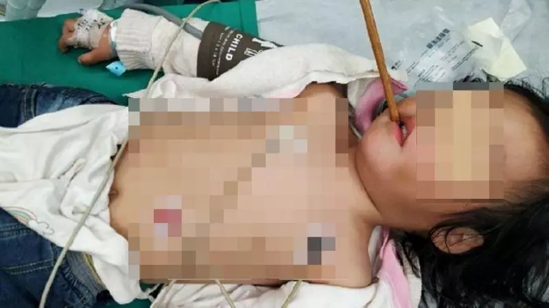 媽媽講的話真的要聽!女童吃飯玩耍「筷子入腦深插10cm」...超驚悚照片曝光:怕爆
