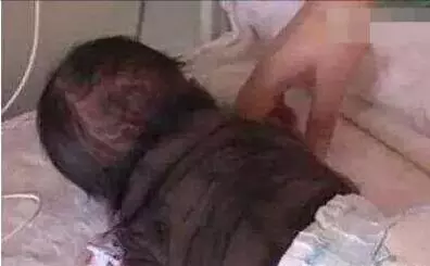 36歲孕婦二胎產下怪胎,全身長毛像「小猩猩」,醫生檢查後怒斥無知!