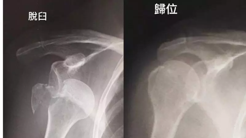 陳美鳳日本踩空急摔 「骨頭痛到打麻醉」手臂脫臼