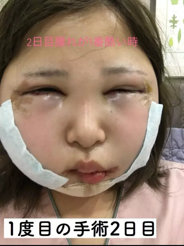 「你的樣子會為他人帶來不幸」 老爸一句話讓日本少女花400萬整形