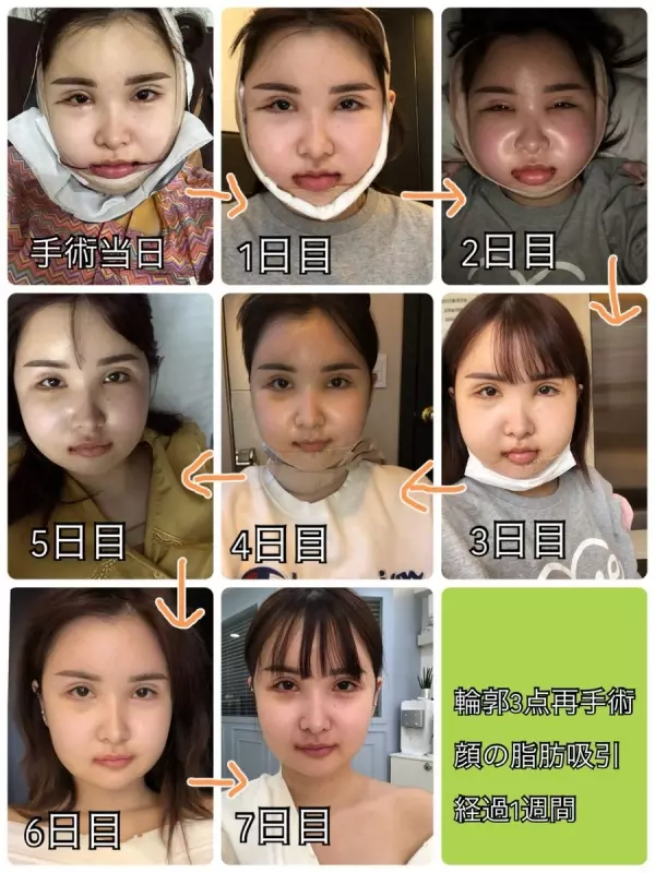 「你的樣子會為他人帶來不幸」 老爸一句話讓日本少女花400萬整形