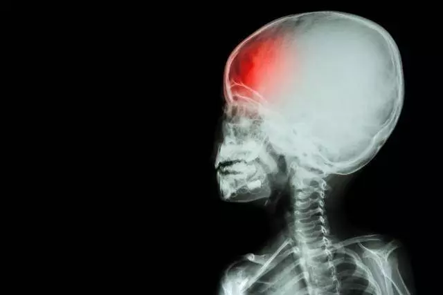 中風為何越來越多?醫生苦勸:這3件事危害很大,很多人卻還在做