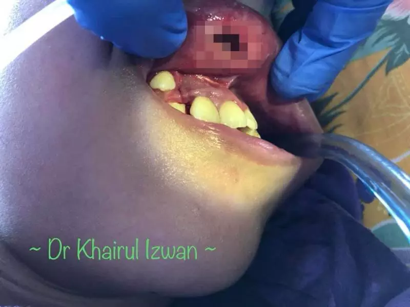 ◤噁心慎入◢ 腦癱少女上唇腫脹 傷口竄出成堆蛆蟲