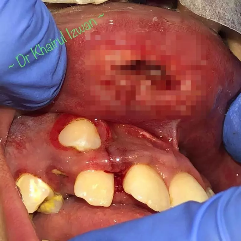 ◤噁心慎入◢ 腦癱少女上唇腫脹 傷口竄出成堆蛆蟲