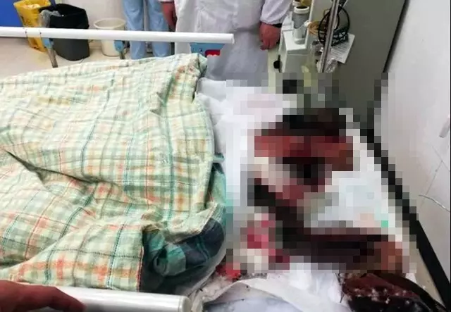 男交往1個月就被甩!怒砍前女友,頭骨碎裂、顱內出血仍然昏迷不醒!