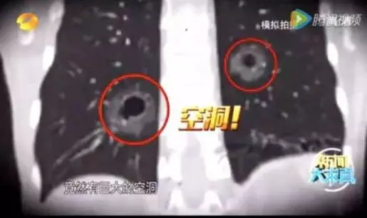 小心,避免這樣吃螃蟹! 中國男童生吃螃蟹,吞下寄生蟲入侵肺腦!