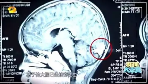 小心,避免這樣吃螃蟹! 中國男童生吃螃蟹,吞下寄生蟲入侵肺腦!