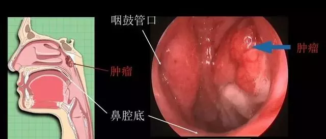 你以為是上火,其實是「癌」!7歲娃也中招!