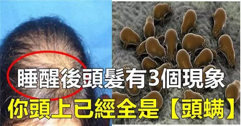 早上起來,頭髮有這3個現象,說明你頭上全是【頭蟎】了!