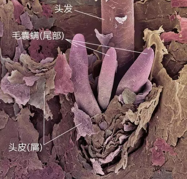 早上起來,頭髮有這3個現象,說明你頭上全是【頭蟎】了!