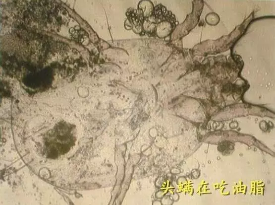 早上起來,頭髮有這3個現象,說明你頭上全是【頭蟎】了!