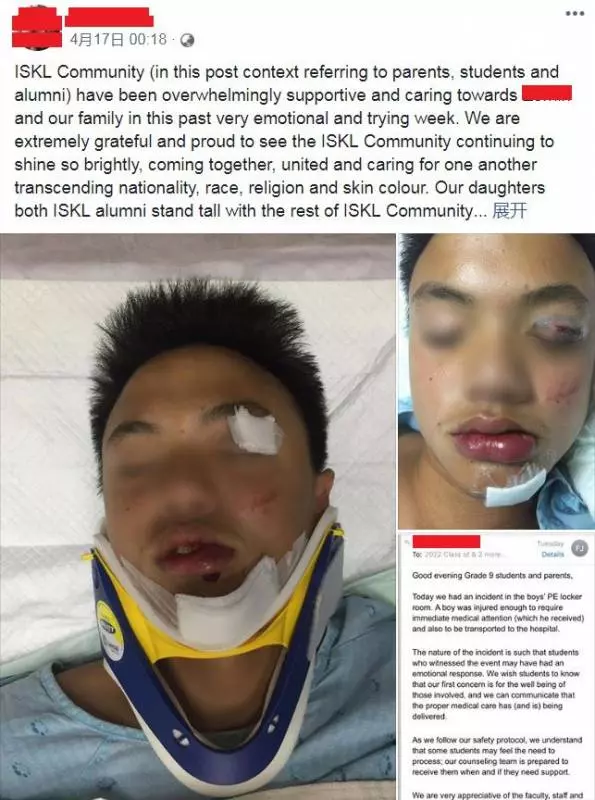 名國際學校霸凌事件 15歲華裔生險變獨眼龍