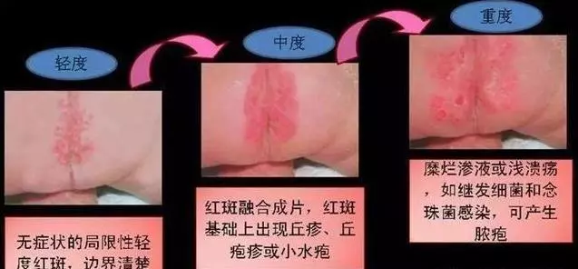 寶寶紅屁股,難受哭鬧愁壞媽媽,傳授你5招,讓孩子告別紅PP
