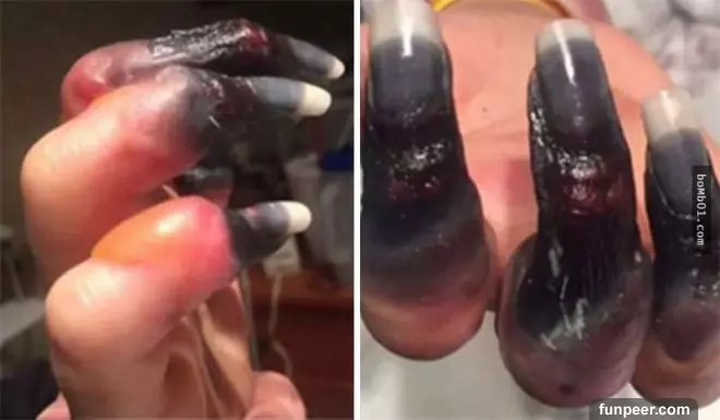 她一開始以為自己「喉嚨發炎」沒發現異樣,直到手指腳趾開始變黑…最後差點就死掉!