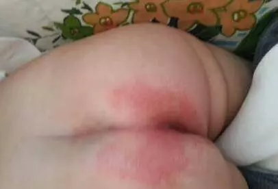寶寶紅屁股,難受哭鬧愁壞媽媽,傳授你5招,讓孩子告別紅PP