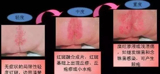 寶寶紅屁股,難受哭鬧愁壞媽媽,傳授你5招,讓孩子告別紅PP