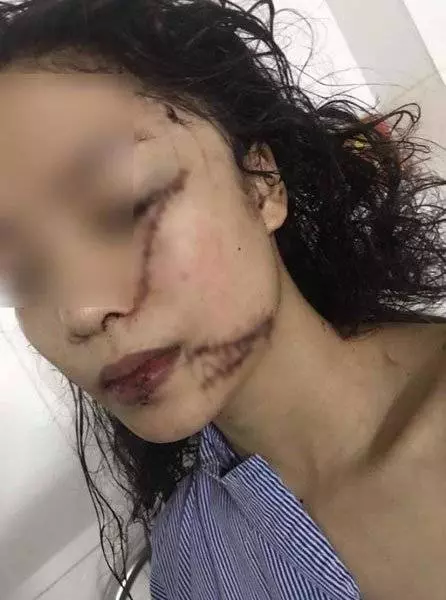搬家問題4女口角 美少女遭割臉縫60針