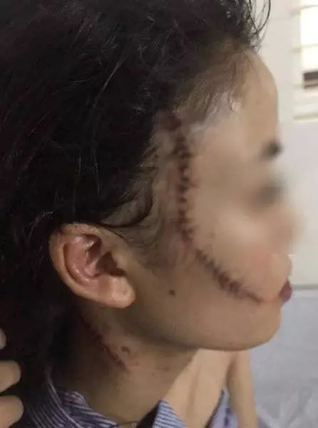 搬家問題4女口角 美少女遭割臉縫60針