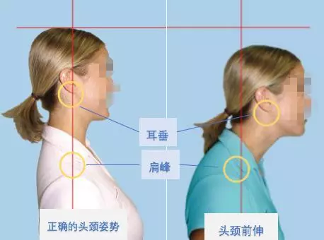 終於找到頸痛頭痛的「罪魁禍首」,專家說:此方法可以逆轉頸椎變直的,快速活血緩解疼痛,遠離頸椎病