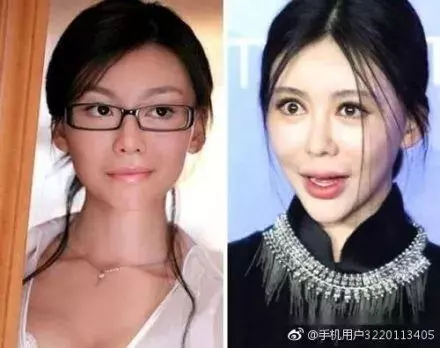 玻尿酸是填充劑不是防腐劑,用量過度的女星,你還忍心看嗎?