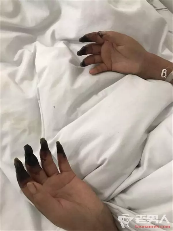 震驚!婦人打掃完家裡「8根指頭焦黑」慘變枯枝!連醫生也搖頭嘆:她太粗心了......