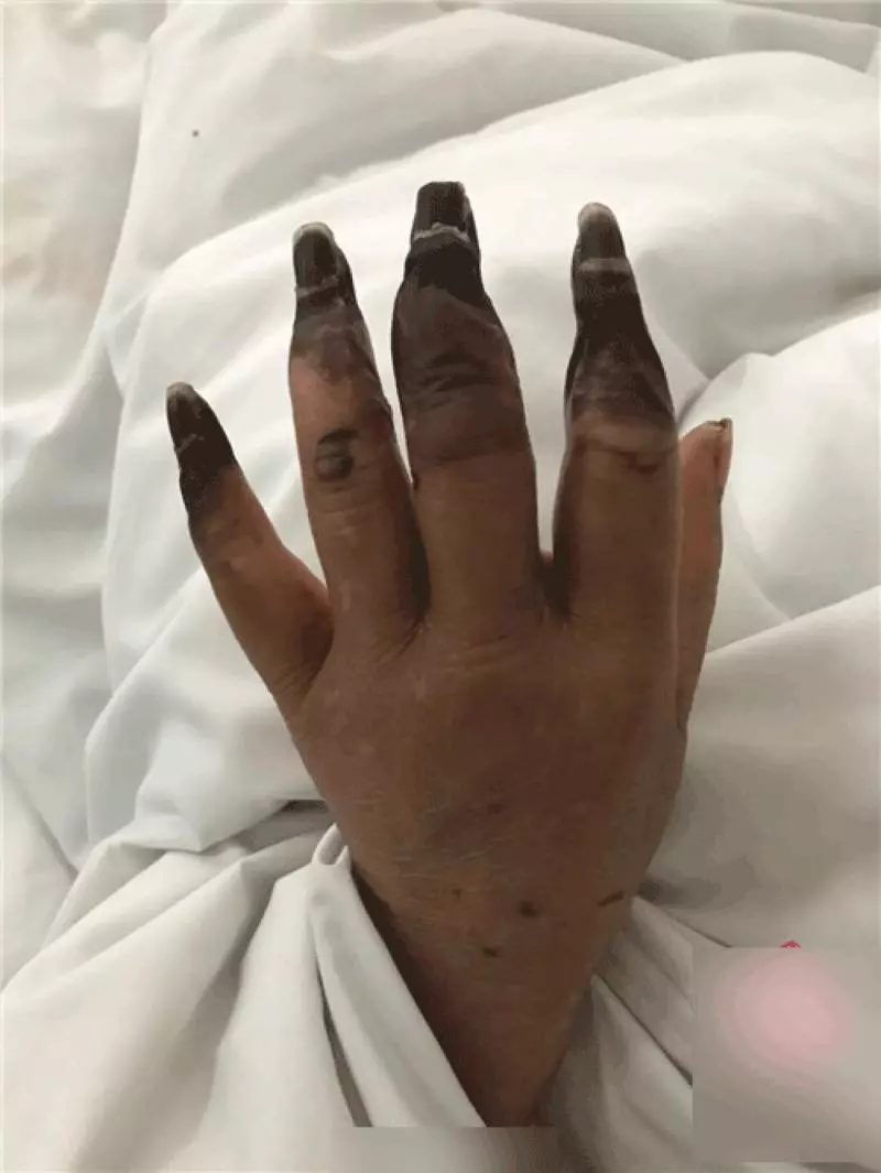 震驚!婦人打掃完家裡「8根指頭焦黑」慘變枯枝!連醫生也搖頭嘆:她太粗心了......