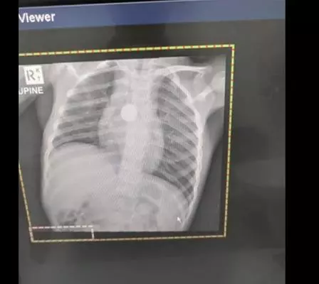 女兒莫名其妙瘦成一根柴,送檢查醫生叫把項鍊拿掉!母回:根本沒戴!醫生:糟了,快動手術