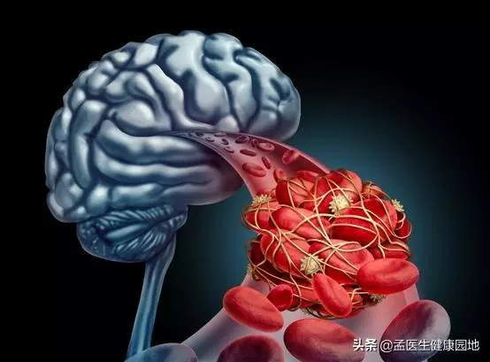 預防腦血管疾病,養護血管,遠離血栓,需要做好五件事!