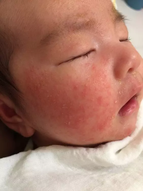 【懷孕不可以啪啪?】女星不信邪,結果跟傳說一樣,寶寶臉紅疹發臭!醫生出來解釋了~