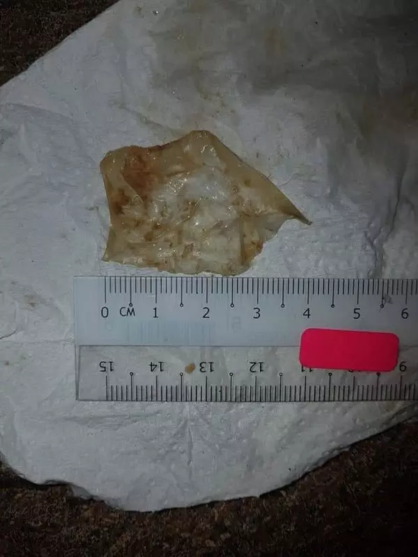 《注意》兒子感冒醫不好 鼻子拉出3厘米塑料