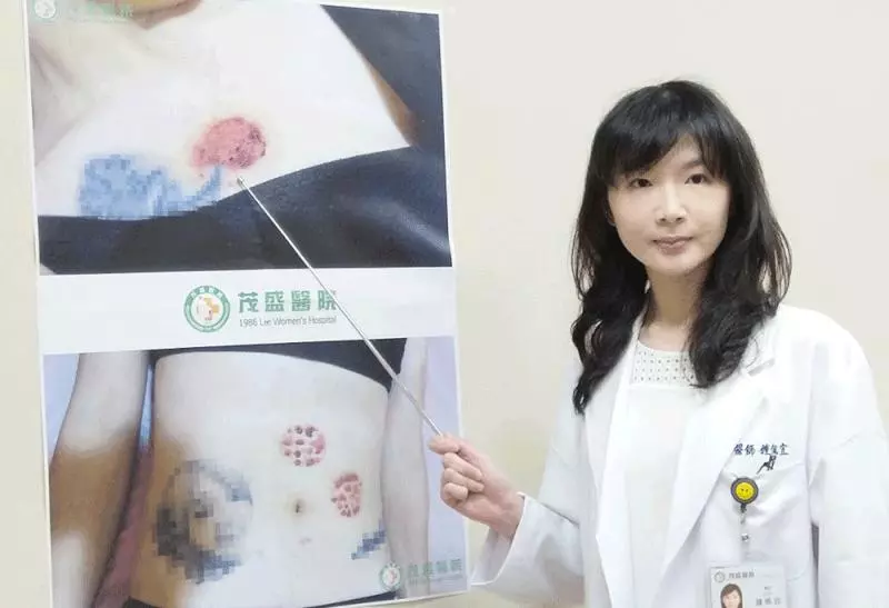 妙齡女自己拔罐睡著,冒出30個水泡痛醒!醫師:別超過這個時間