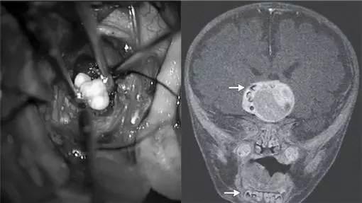 前所未見!四月大男嬰做腦瘤手術 醫師挖出一顆牙齒嚇壞