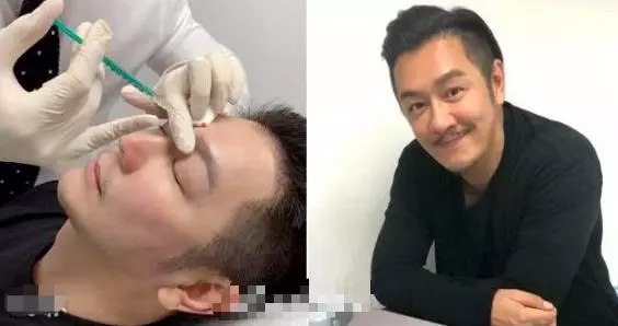陳浩民曬醫美照!毫不避諱自己做微調,男明星為「美」也這麼拼?