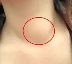 百病之源,血瘀症!千萬不要輕視,看看有你嗎