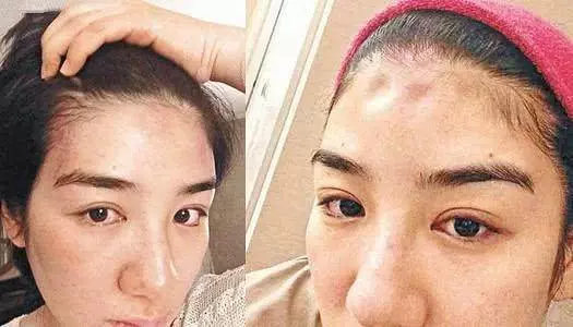 女星遭51歲富商男友家暴,打成腦震蕩頭骨骨折還吐血慘不忍睹~