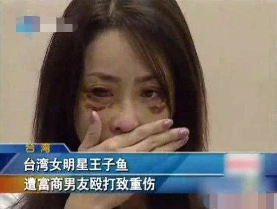 女星遭51歲富商男友家暴,打成腦震蕩頭骨骨折還吐血慘不忍睹~