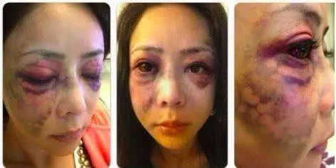 女星遭51歲富商男友家暴,打成腦震蕩頭骨骨折還吐血慘不忍睹~
