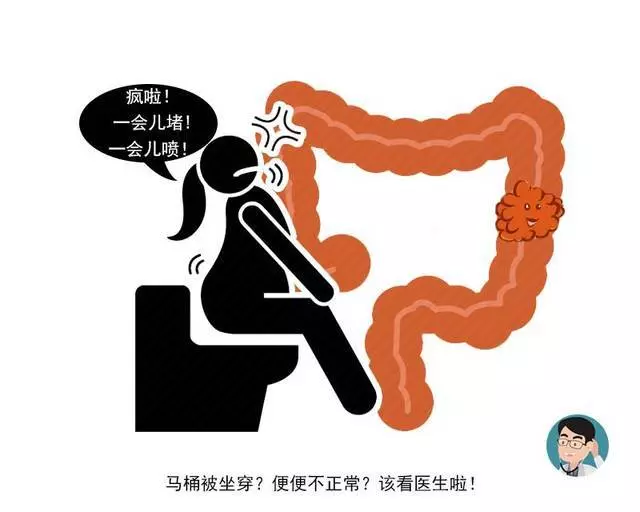 一天幾十個屁暗示有腸道癌?醫生:出現這3個異常才需警惕