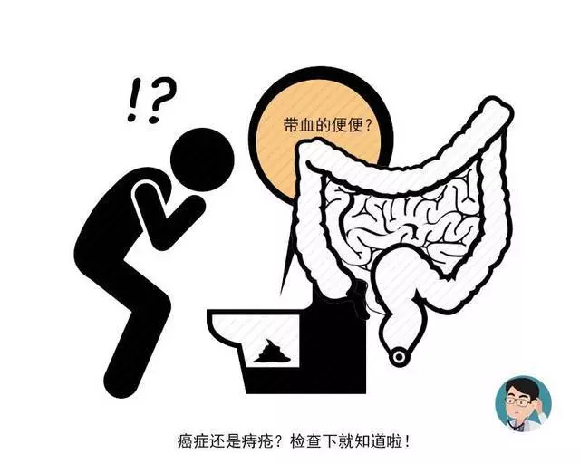 一天幾十個屁暗示有腸道癌?醫生:出現這3個異常才需警惕