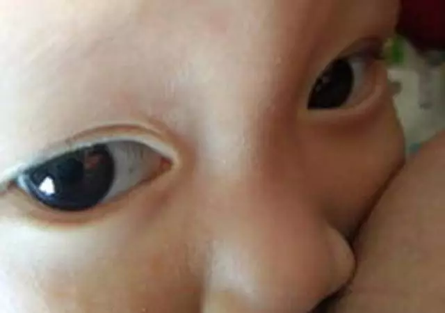 寶寶眼白上的黑斑是什麼?難道真的是因為肚子裡有蟲?很多家長都做錯了