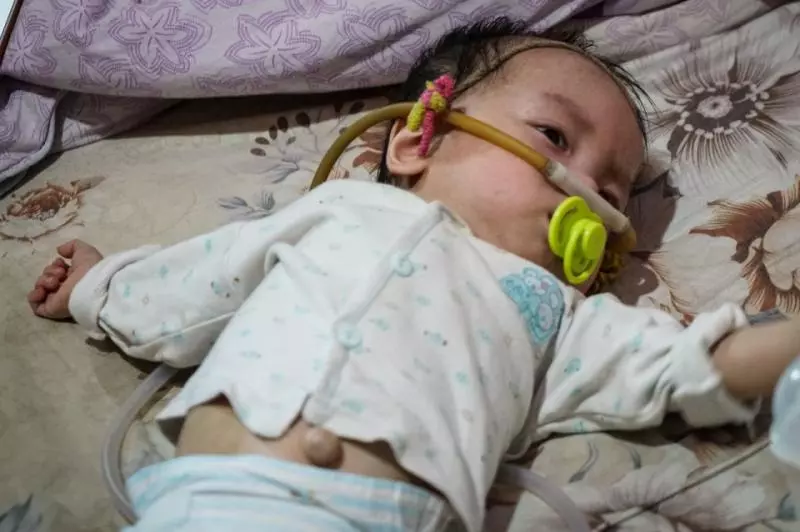 2歲寶寶患重症似嬰兒般大小,靠一台呼吸機活著:一定要撐到5歲