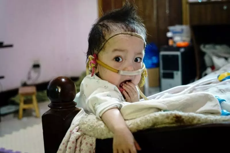 2歲寶寶患重症似嬰兒般大小,靠一台呼吸機活著:一定要撐到5歲