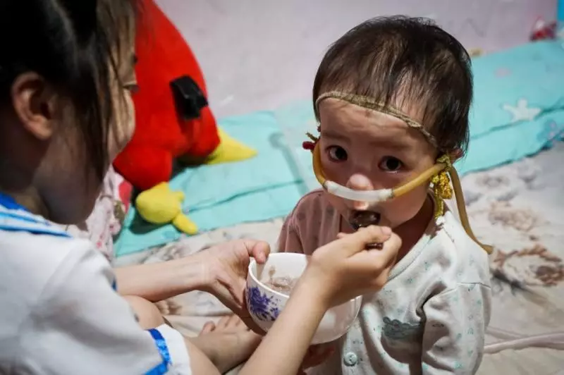 2歲寶寶患重症似嬰兒般大小,靠一台呼吸機活著:一定要撐到5歲